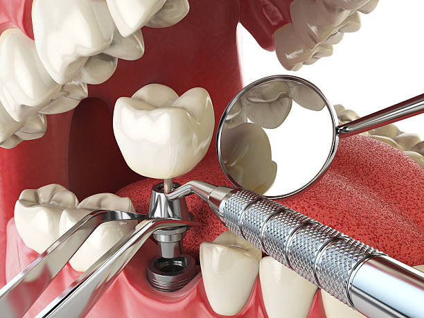 Best Broken or Chipped Tooth Repair in Russell, GA